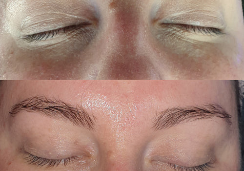 Brisbane's Best Facial - Dermal Infusion