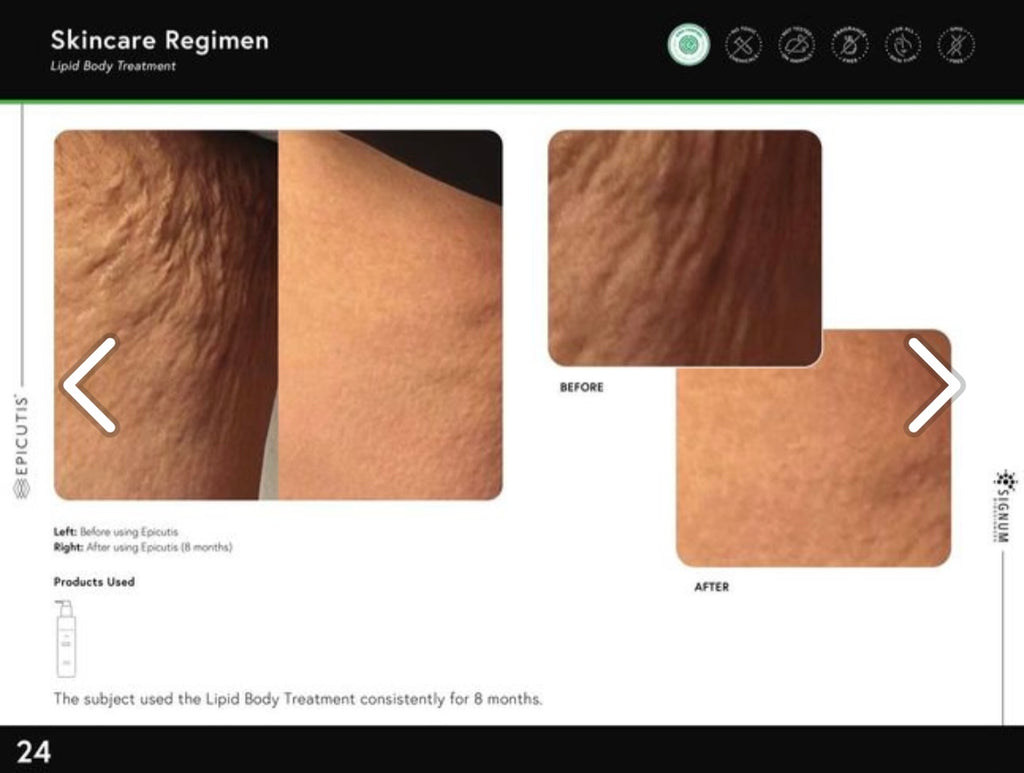 EPICUTIS® Lipid Body Treatment
