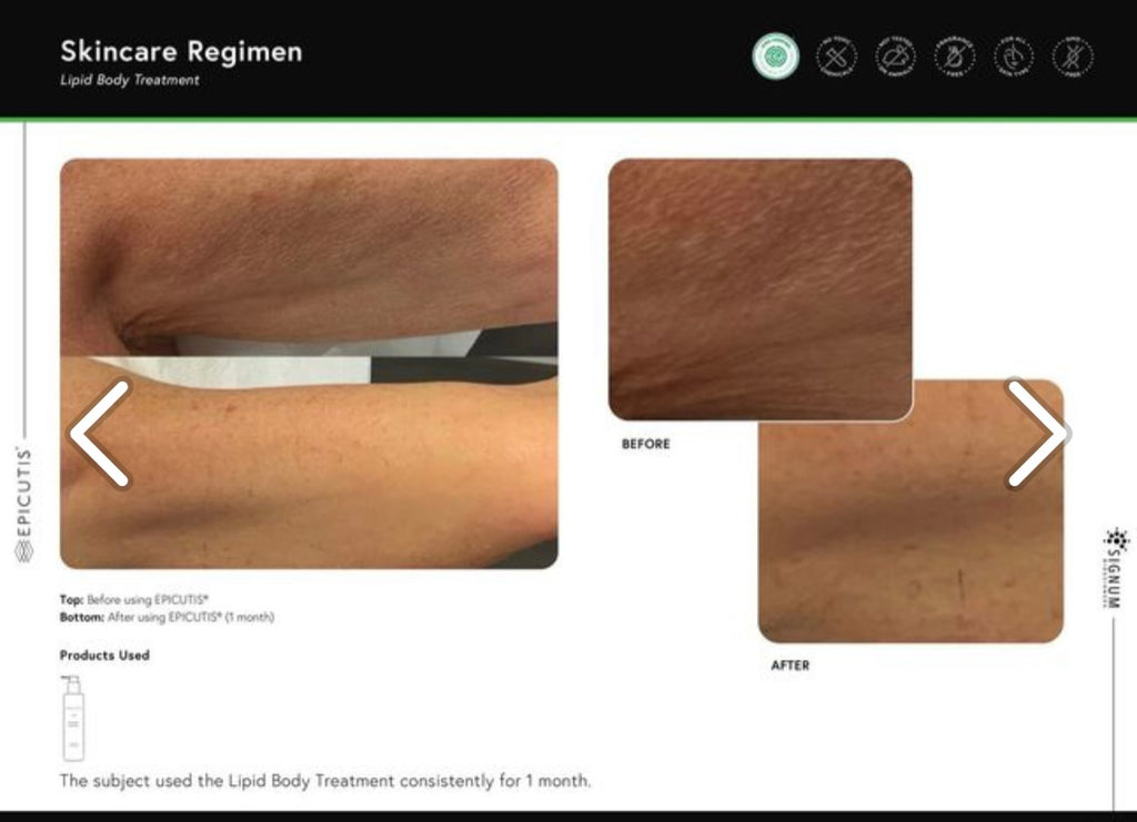 EPICUTIS® Lipid Body Treatment